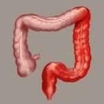 Diagnóstico de colitis ulcerativa
