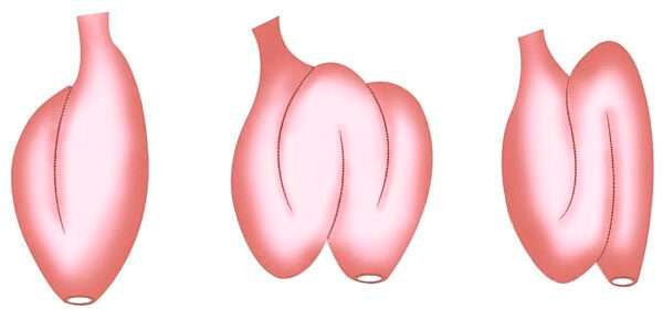 Cirugía en la Colitis Ulcerosa