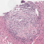 Colangitis biliar primaria