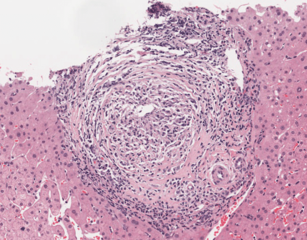 Colangitis biliar primaria