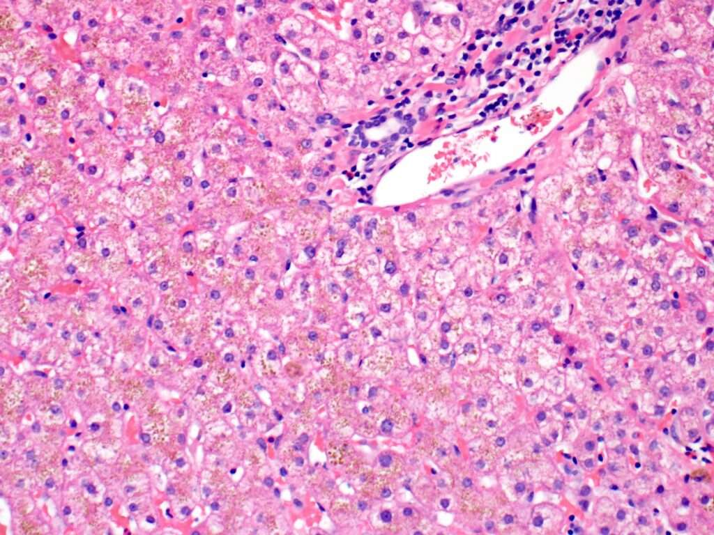Hemocromatosis