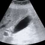 Colecistitis aguda