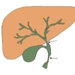 Estenosis biliares
