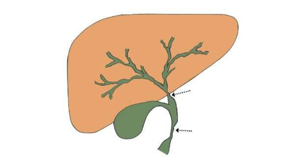 Estenosis biliares
