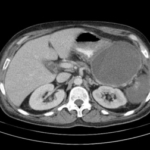 Complicaciones de la pancreatitis aguda