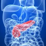 Pautas para el tratamiento de la pancreatitis severa