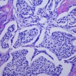 Tumores neuroendocrinos gastroenteropancreáticos y tumores carcinoides.