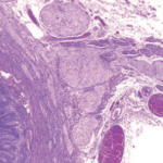 Neoplasia endocrina múltiple