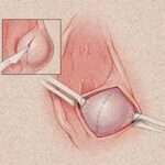 ¿Qué sucede cuando se obstruye el conducto de la glándula de Bartolino?