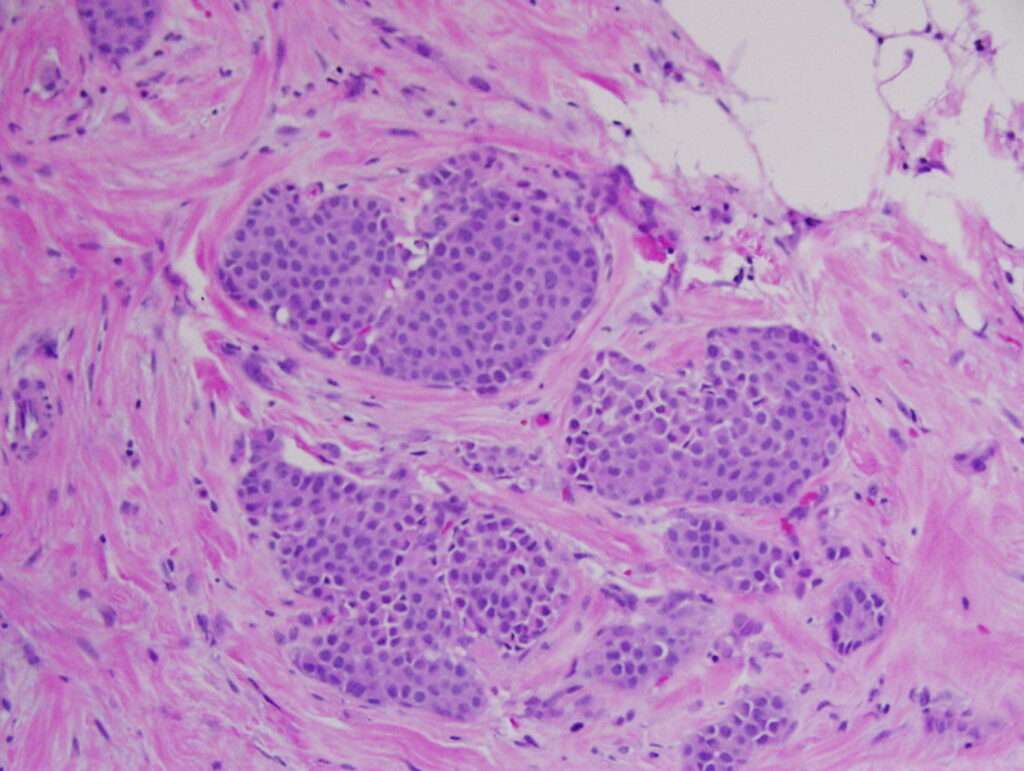 Subtipos patológicos del cáncer de mama