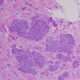 Subtipos patológicos del cáncer de mama