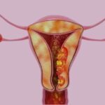 Carcinoma de endometrio