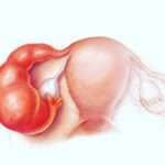 Enfermedad pélvica inflamatoria