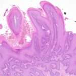 ¿Qué es el condiloma acuminado?