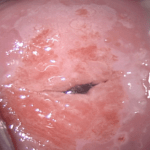 Neoplasia intraepitelial cervical