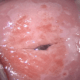 Neoplasia intraepitelial cervical