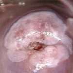 Carcinoma del cuello uterino