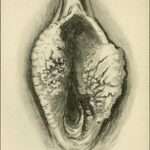 Carcinoma de vulva