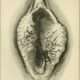 Carcinoma de vulva
