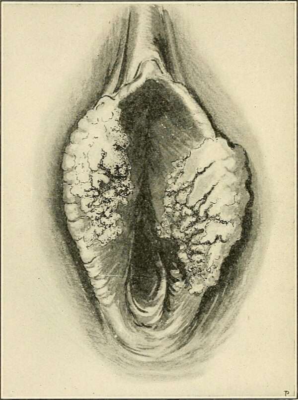 Carcinoma de vulva