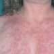 Lupus inducido por medicamentos