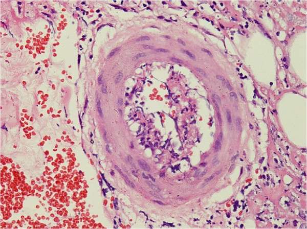 Poliarteritis nodosa