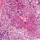 Granulomatosis con poliangiitis (granulomatosis de Wegener)