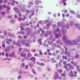 Granulomatosis eosinofílica con poliangeítis (síndrome de Churg-Strauss)