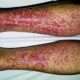 Crioglobulinemia