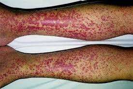 Crioglobulinemia