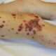 Vasculitis IgA (Henoch-Schönlein purpura)