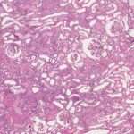 Necrosis tubular aguda