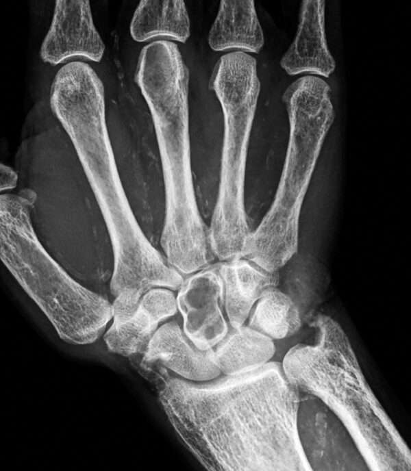 Trastornos minerales óseos en pacientes con enfermedad renal crónica