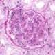Glomerulonefritis por Complejos Inmunes: Glomerulonefritis relacionada con infecciones y postinfecciosa.