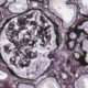Glomerulonefritis por anticuerpos contra la membrana basal glomerular y síndrome de Goodpasture