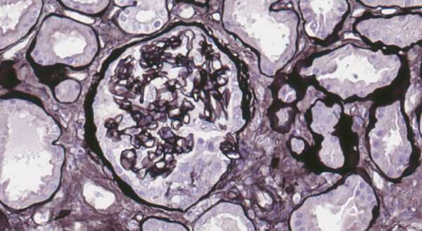 Glomerulonefritis por anticuerpos contra la membrana basal glomerular y síndrome de Goodpasture