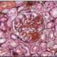Glomerulonefritis por Inmunoglobulina Monoclonal