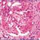 Glomeruloesclerosis segmentaria focal