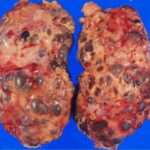 Enfermedad renal poliquística autosómica dominante