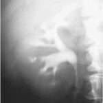 Riñón esponjoso medular