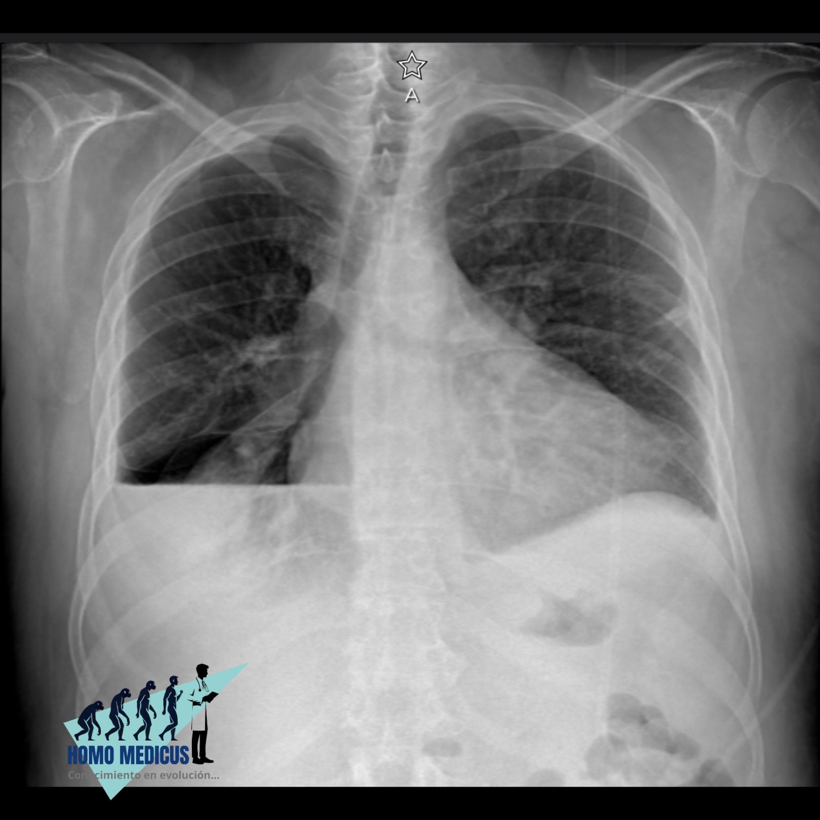 Derrame pleural Derrame pleural