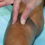 Fibrosis sistémica nefrogénica