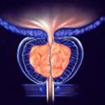 Prostatitis bacteriana aguda