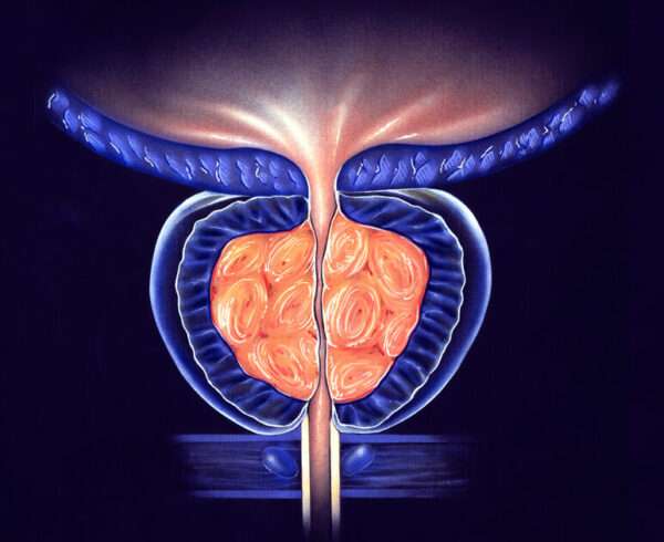 Prostatitis bacteriana aguda