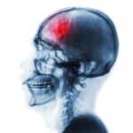 Cefalea debido a lesiones intracraneales