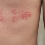 ¿Qué es la neuralgia postherpética?