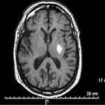 ¿Qué es un infarto lacunar?