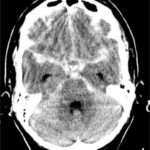 Hemorragia subaracnoidea espontánea