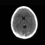 Trombosis venosa intracraneal