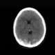 Trombosis venosa intracraneal